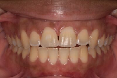 Anterior open bite after