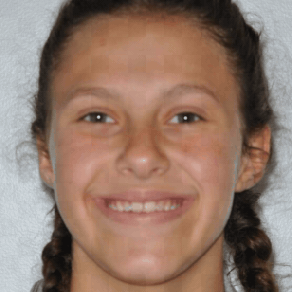 600×600 Young patient before orthodontic braces treatment at glass orthodontics in elizabeth city, nc