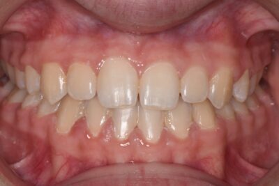 Before & after 6 After orthodontic treatment corrected open bite and improved alignment in chesapeake va at glass orthodontics