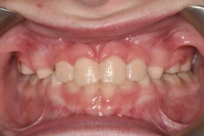Before & after 10 After orthodontic treatment improved alignment and bite correction in chesapeake va at glass orthodontics serving elizabeth city nc and moyock nc