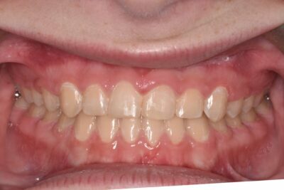 Before & after 12 After orthodontic treatment straight teeth and improved bite in chesapeake va at glass orthodontics serving elizabeth city nc and moyock nc