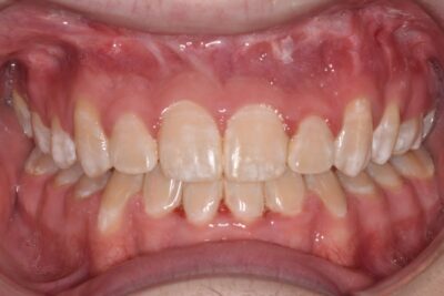 Before & after 14 After orthodontic treatment straight teeth and improved bite alignment in chesapeake va at glass orthodontics serving elizabeth city nc and moyock nc