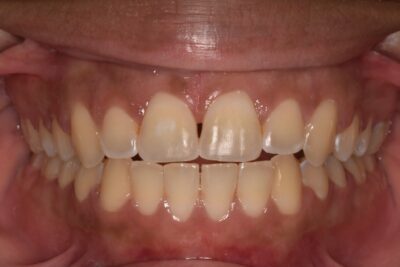 Before & after 8 After orthodontic treatment straight teeth and improved alignment in chesapeake va at glass orthodontics