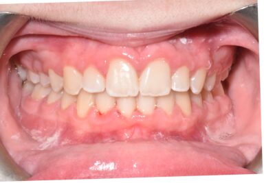 Before & after 18 After orthodontic treatment with straight teeth and corrected bite in chesapeake va at glass orthodontics