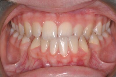 Before & after 5 Before orthodontic treatment showing open bite and spacing in chesapeake va at glass orthodontics serving elizabeth city nc and moyock nc