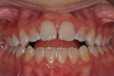 Before & after 7 Before orthodontic treatment crowded teeth and misalignment in chesapeake va at glass orthodontics serving elizabeth city nc and moyock nc