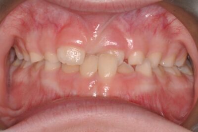 Before & after 9 Before orthodontic treatment showing crowding and bite misalignment in chesapeake va at glass orthodontics serving elizabeth city nc and moyock nc