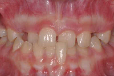 Before & after 11 Before orthodontic treatment showing spacing and misaligned teeth in chesapeake va at glass orthodontics serving elizabeth city nc and moyock nc
