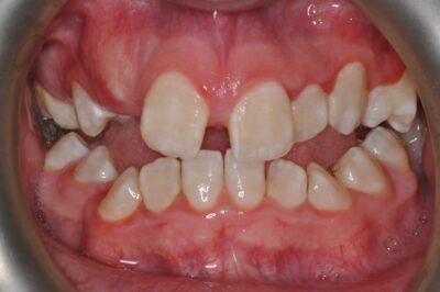Before & after 13 Before orthodontic treatment showing crowding and misaligned teeth in chesapeake va at glass orthodontics serving elizabeth city nc and moyock nc