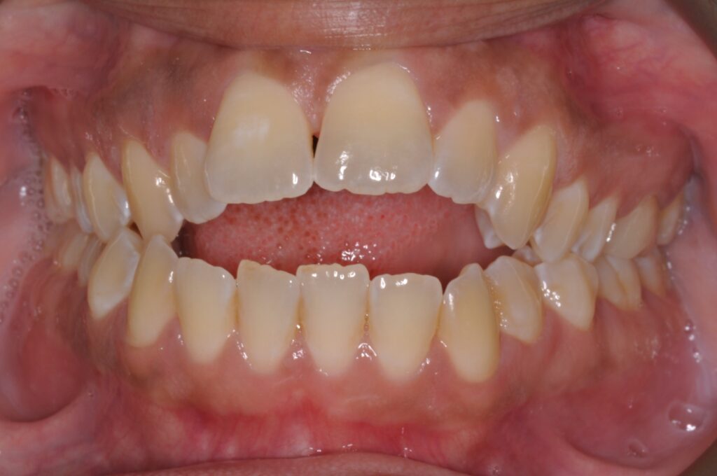 Before & after 15 Before orthodontic treatment showing open bite and crowded teeth in chesapeake va at glass orthodontics serving elizabeth city nc and moyock nc