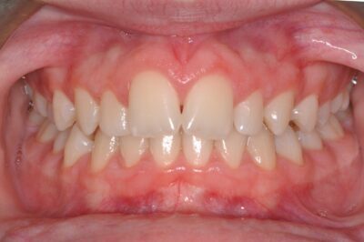 Before & after 17 Before orthodontic treatment showing crowded teeth and bite misalignment in chesapeake va at glass orthodontics