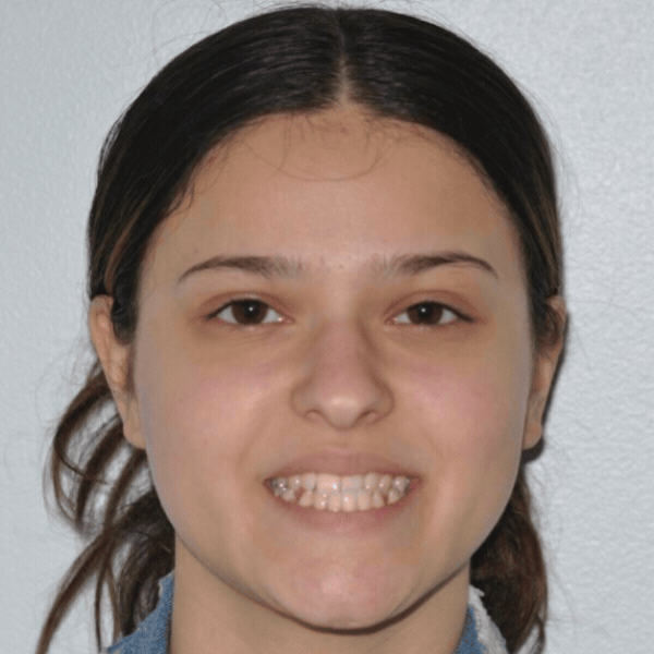 Glass-ortho-before-after-1 Young patient before orthodontic braces treatment at glass orthodontics in elizabeth city, nc