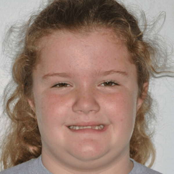 Glass-ortho-before-after-3 Young patient before orthodontic braces treatment at glass orthodontics in elizabeth city, nc