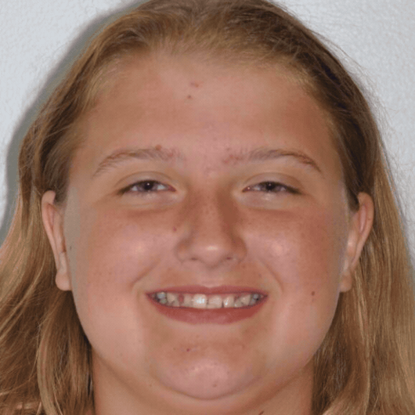 Glass-ortho-before-after-4 Teen patient before braces treatment at glass orthodontics in elizabeth city, nc