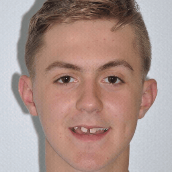 Glass-ortho-before-after-5 Teen patient before orthodontic treatment at glass orthodontics in elizabeth city, nc