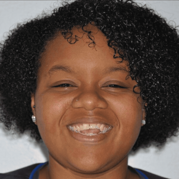 Glass-ortho-before-after-6 Smiling orthodontic patient before braces treatment at glass orthodontics in elizabeth city, nc