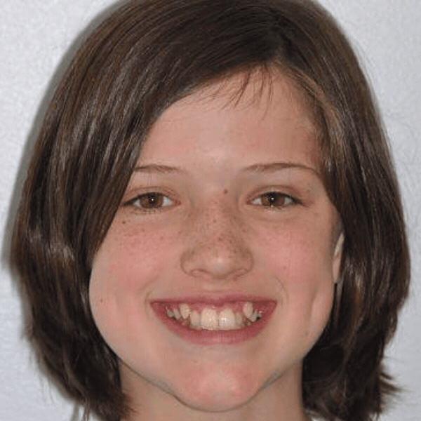 Glass-ortho-before-after-8 Young orthodontic patient before braces treatment at glass orthodontics in elizabeth city, nc