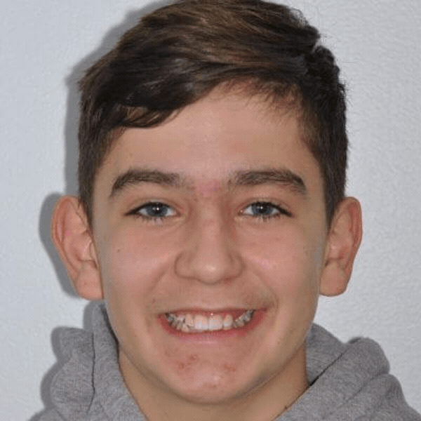 Glass-ortho-before-after-9 Teen patient smiling before orthodontic braces treatment at glass orthodontics in elizabeth city, nc