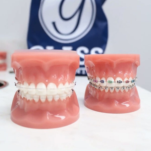 Metal vs ceramic braces Metal and ceramic braces models comparison in chesapeake va at glass orthodontics