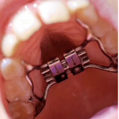 What is palatal expansion? 3 Close up of a palatal expander, representing benefits of palatal expansion